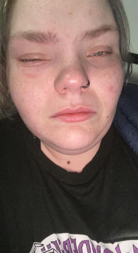 Started swelling around midnight at work, just woke up and now I’m in