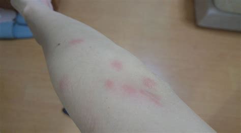 Woman complains of bed bug bites after 2-way S'pore-HK Scoot flights ...
