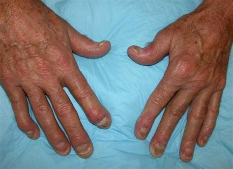 Psoriatic Arthritis Toes