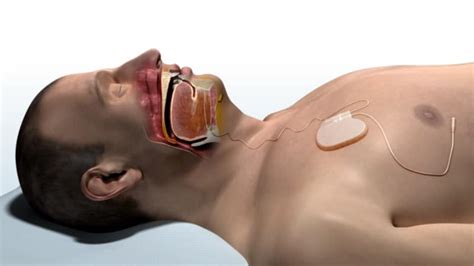 Inspire Spleep Apnea Implant with Valtronic miniaturization - Valtronic