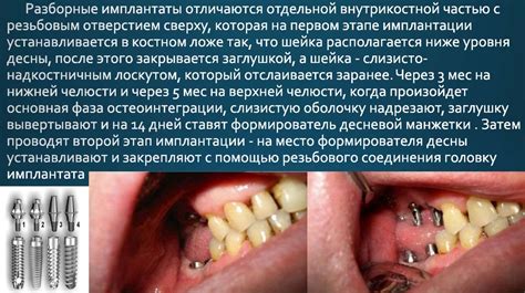 Протезирование съемных протезов на имплантатах - презентация онлайн