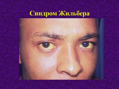 Наследственные семейные гепатозы - презентация онлайн