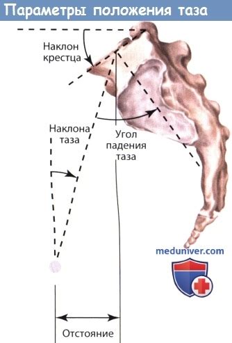 Причины и клиника дегенеративного сколиоза поясничного отдела позвоночника