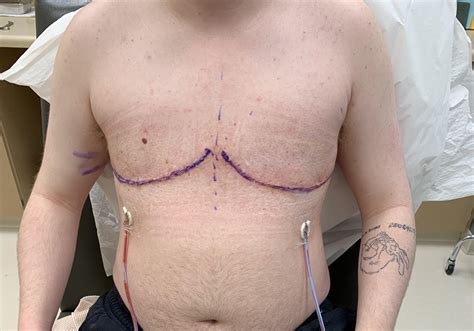 Just had top surgery, big chilling : r/ftm