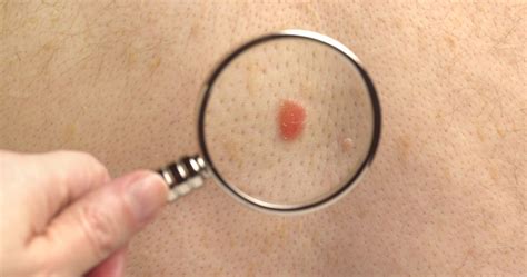 Nodular Melanoma: Symptoms of This Aggressive Cancer