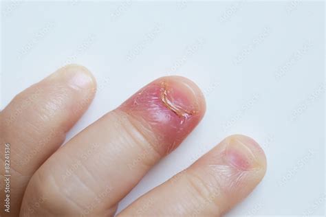 how to fix an infected fingernail