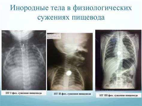 Инородные тела нижних дыхательных путей и пищевода - презентация онлайн