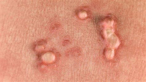 What Are Genital Warts? Symptoms, Causes, Diagnosis, Treatment, and ...