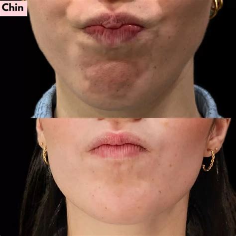 cleft chin  smooth chin    rid   butt chin
