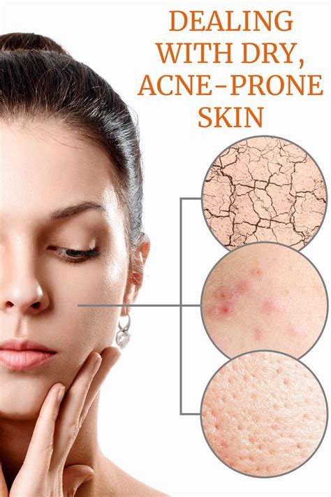 hormonal acne     rid   artofit