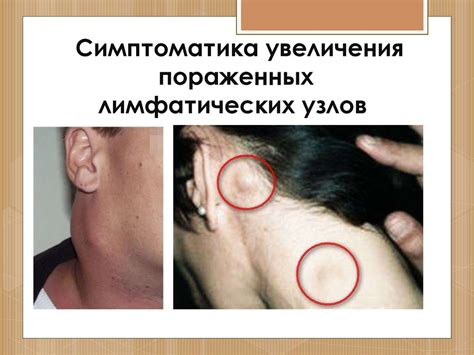 Лимфогранулематоз (болезнь Ходжкина ) - презентация онлайн