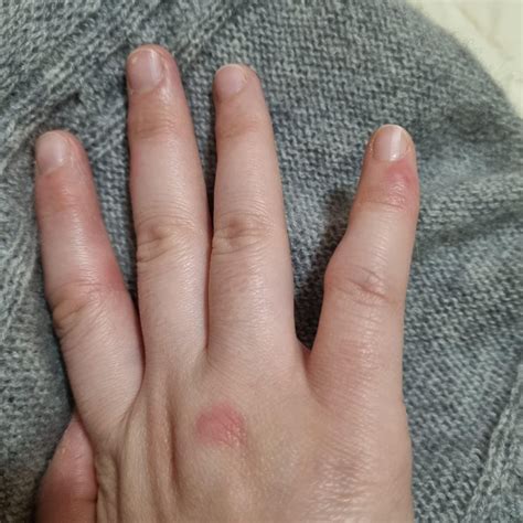Red bumps on fingers (sometimes on other joints too) that get redder ...
