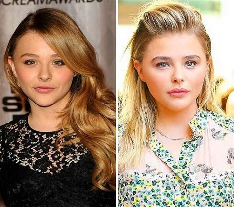 Chloe Moretz Lip Injections