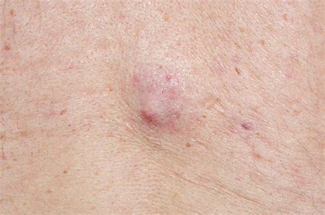 Sebaceous Cyst