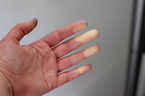 Qu'est-ce que le phénomène de Raynaud?