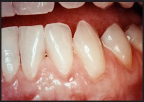 mucogingival procedures goldberg implants periodontics north