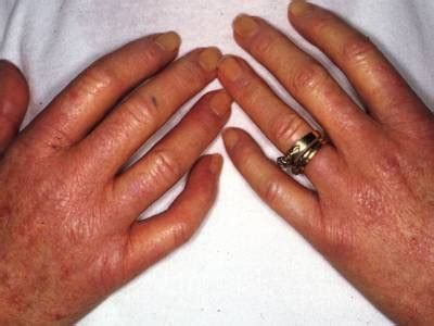 Scleroderma Flashcards | Quizlet