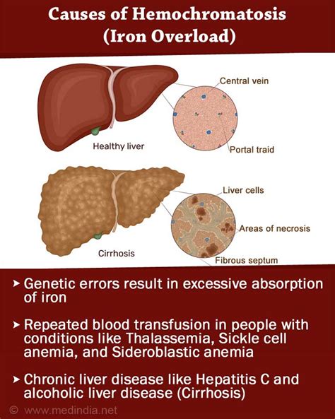 Hemochromatosis (Iron Overload) - Causes, Symptoms, Diagnosis ...