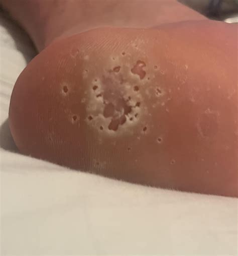 What are the craters on my feet? : r/medical_advice