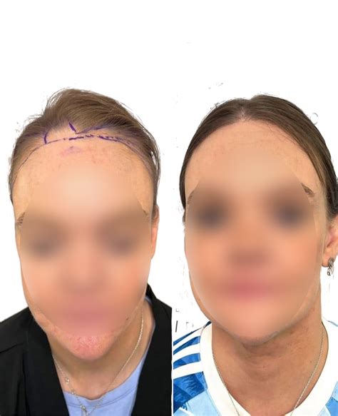 Best FUE Hair Transplant Treatment London UK