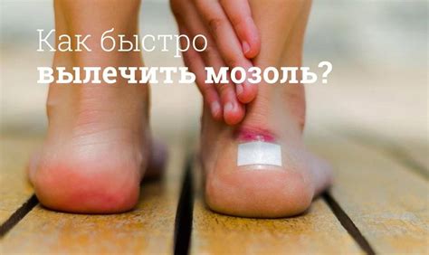 Как лечить стержневую или сухую мозоль | Мегаптека
