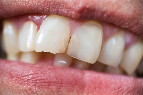 fix  chipped tooth insights  dakabin dental