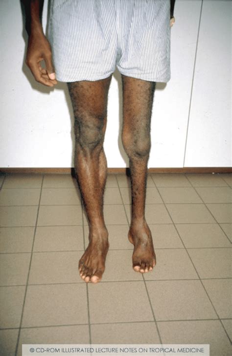Poliomyelitis – WikiTropica