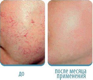 Мазь от сосудистых звездочек на ногах и лице: гепариновая мазь ...