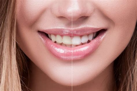 How to Get Rid of Brown Spots on Teeth: Tips to Whiten Your Teeth