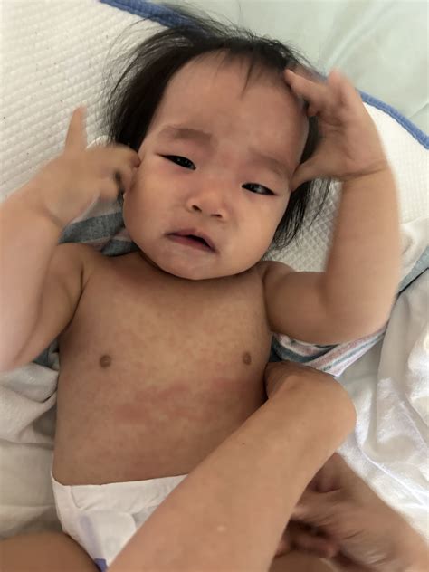 Roseola 玫瑰疹