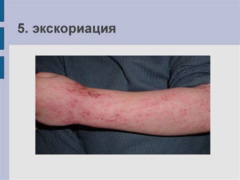 Морфологические элементы сыпи - презентация онлайн