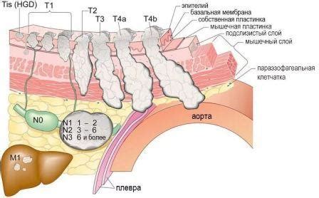 Рак пищевода - классификация, причины, симптомы, лечение