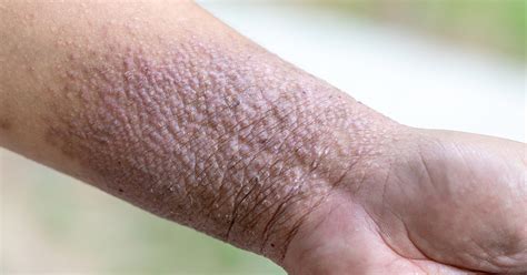 Pustular Psoriasis: Spotting Symptoms and Treating the Condition