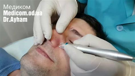 Лазерное удаление сосудов на носу - YouTube