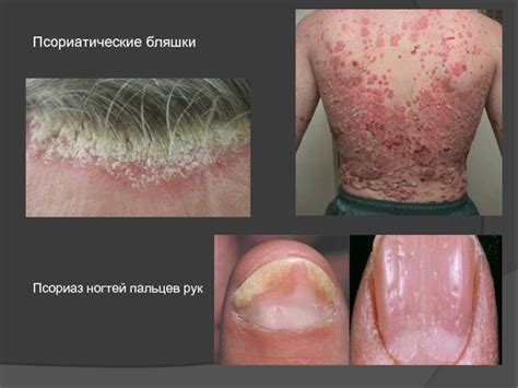 Псориаз. Этиология и патогенез псориаза