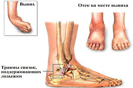 Вывих ноги – что делать и как лечить?