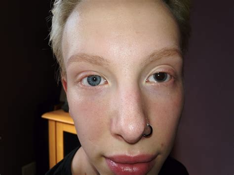 My brothers messed up eyes after one got infected. : r/mildlyinteresting