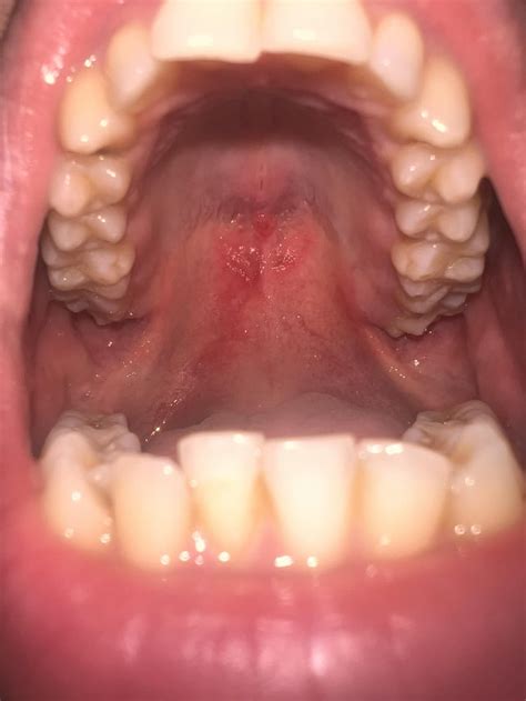 Sore/ pain in palate after doing mewing for 3 days : r/orthotropics