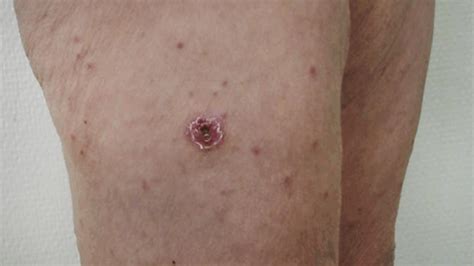 eschar burn figure   burn wound care semantic scholar