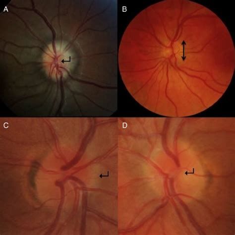 Surface and buried optic nerve head drusen. The disc is elevated and... | Download Scientific ...