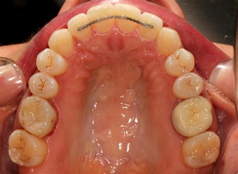 Maxillary Skeletal Expander (MSE) - Lemke Orthodontics | Sugar Land ...