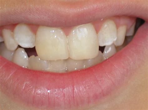 Cosmetic Composite Bonding - Weston Dental : Weston Dental
