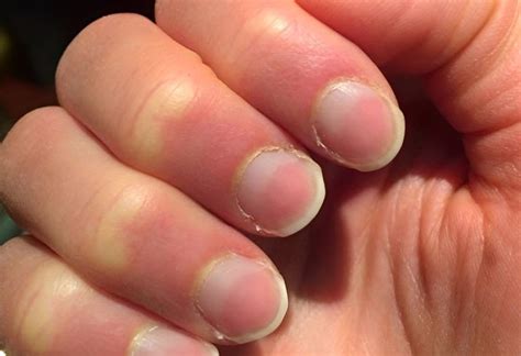 nail problems explained easy ways  spot  prevent issues