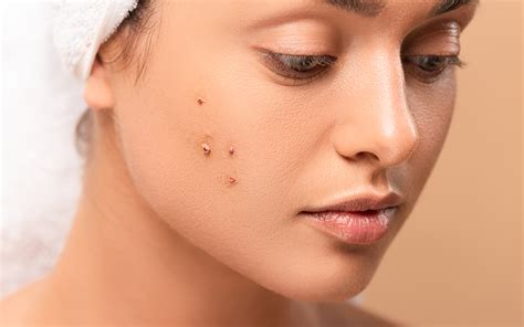 How to Correctly Use Pimple Patches | Tips for Thought