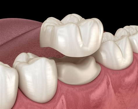 Should You Get Porcelain Crowns? | Tooth Crown 101 | VIDA