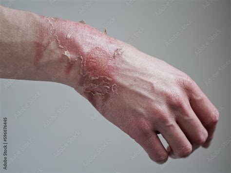 close    womans hand   burst blister   boiled water