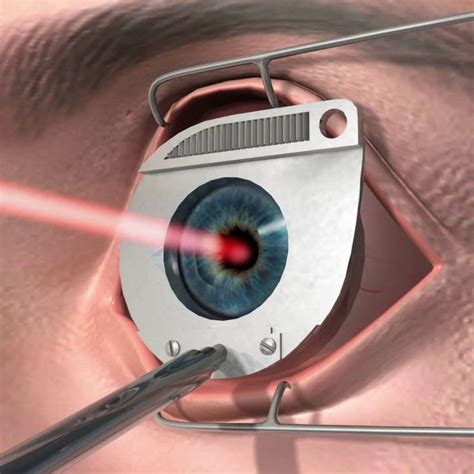 Astigmatism Surgery - Assoc. Prof. Dr. Mehmet Tetikoğlu