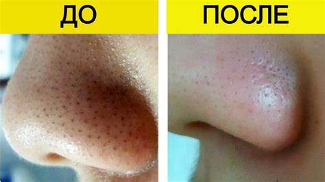 Натуральная маска от черных точек: Избавься от черных точек навсегда ...