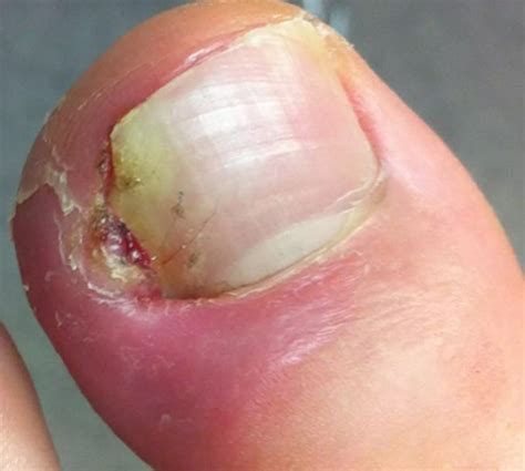 Type 2 Diabetes With Foot Infection Icd 10 at Hunter Wang blog