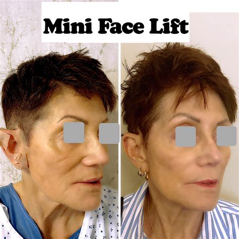 Facelift Surgery: The Psychological Impact of Boosting Confidence